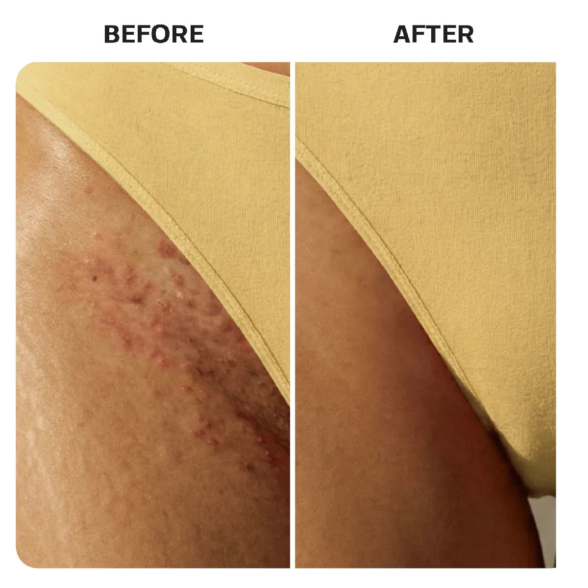 Ingrown Hair Complete Extraction Kit - Image 13