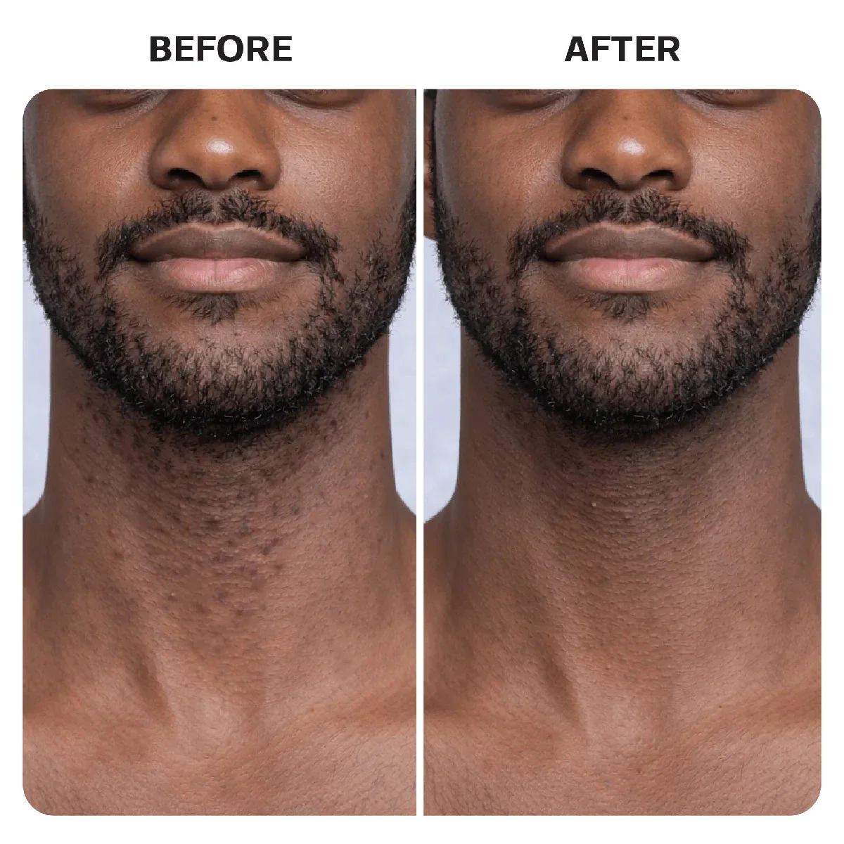 Ingrown Hair Complete Extraction Kit - Image 16