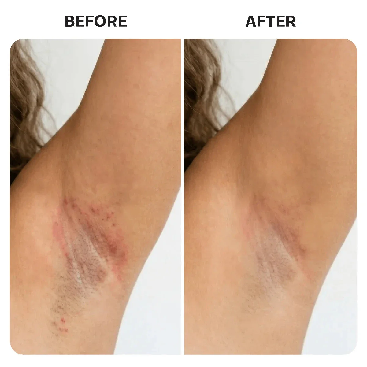 Ingrown Hair Complete Extraction Kit - Image 17