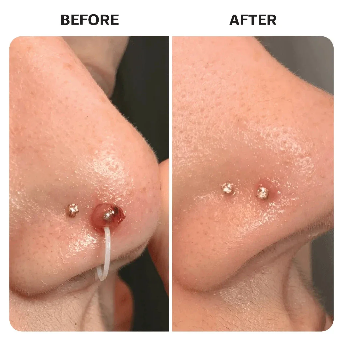 Piercing Bump Recovery Duo - Image 7